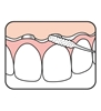 نحوه استفاده از نخ دندان مخصوص ایمپلنت